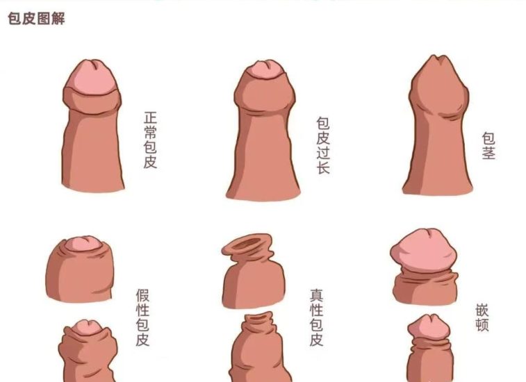 割包皮真的能让时间更持久、更爽,鸡鸡变长吗-广州器具大师网络运营中心