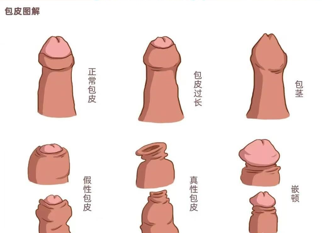 割包皮真的能让时间更持久、更爽,鸡鸡变长吗插图3 20261009181550890-bd425a0ade2fdadfb31333fdab440941
