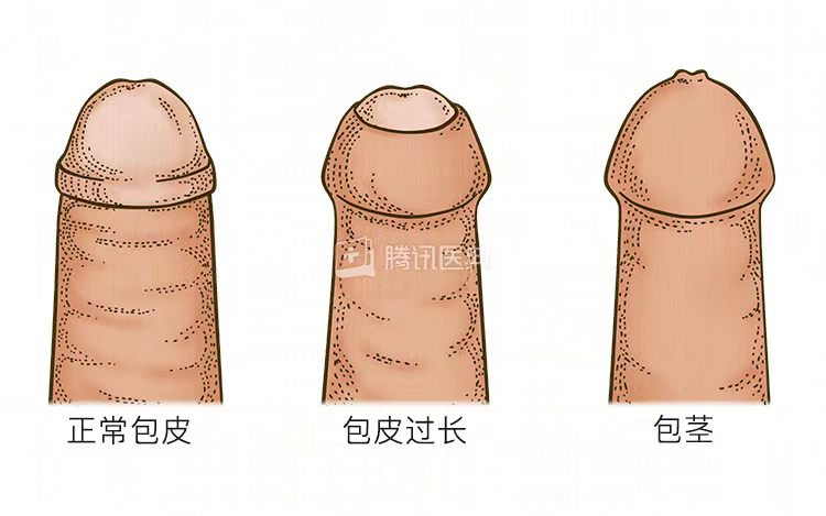割包皮真的能让时间更持久、更爽,鸡鸡变长吗插图2 20261009181612713-ba83c0b3e8962c2e005403ccf4a37087